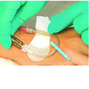 McArthur Medical Grip-Lok Securement Device